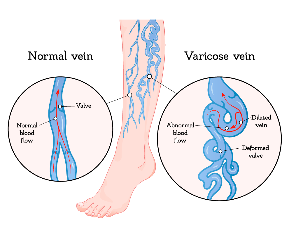 An illustration of varicose veins versus normal veins